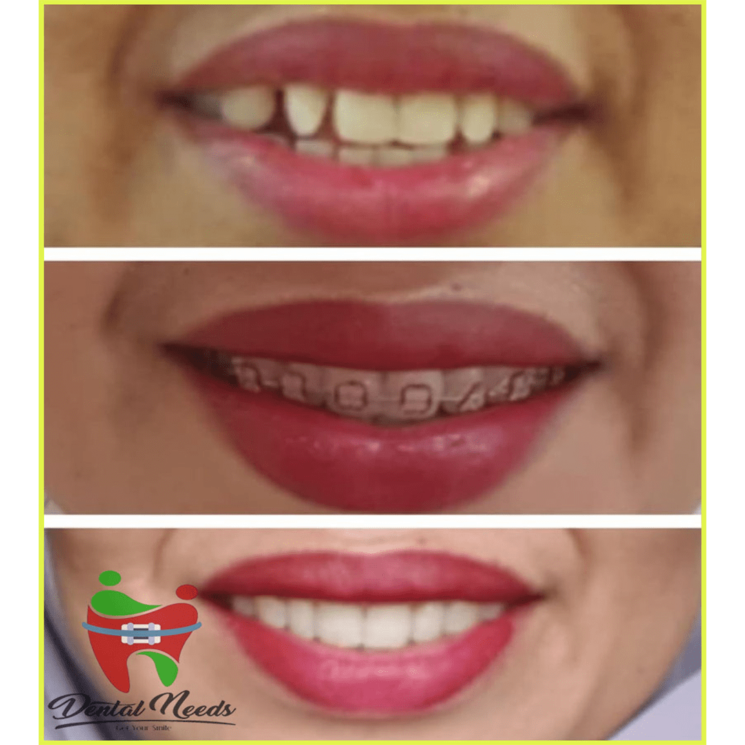 Before-after Perawatan Estetik dan Preventif